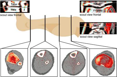 Between-Subject and Within-Subject Variation of Muscle Atrophy and Bone Loss in Response to Experimental Bed Rest